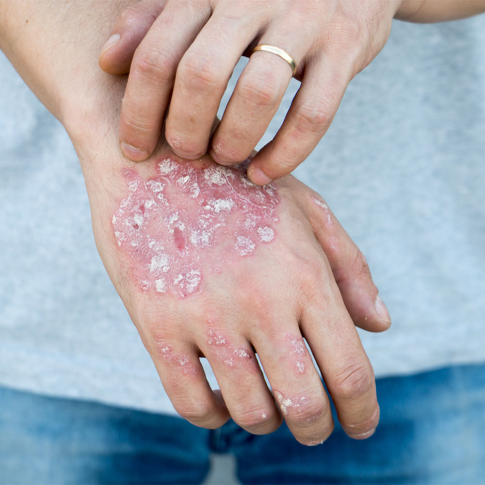latest research into psoriasis